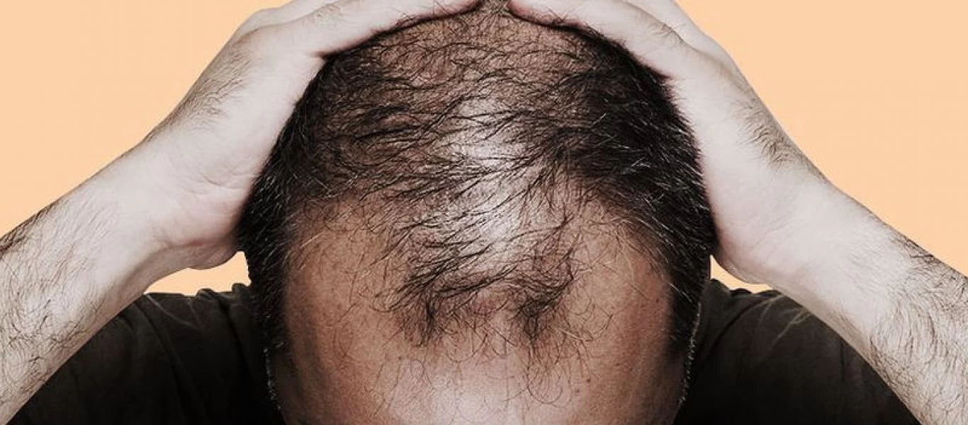 Τριχόπτωση: Έξι τροφές που την καταπολεμούν